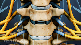Medical illustration of two vertebrae. The disc between the vertebrae has been removed in preparation for a disc replacement