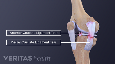 Knee joint labeling MCL and ACL