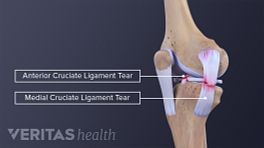 Profile view of the knee joint with torn MCL and torn ACL