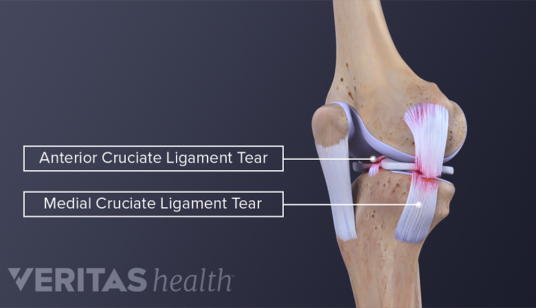 Guide  Physical Therapy Guide to Posterior Cruciate Ligament