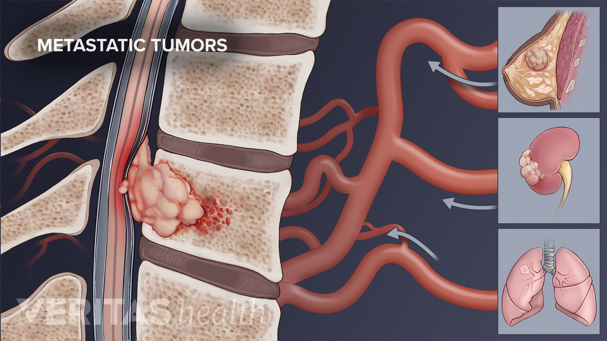 Could My Back Pain Be Spine Cancer Spine Health   MetastaticTumors 