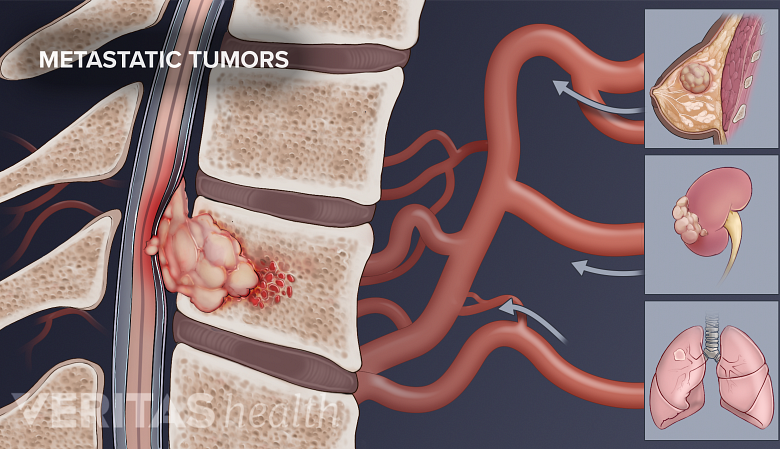 Illustration showing spinal tumor spread from lungs, kidney, and breast tumor.