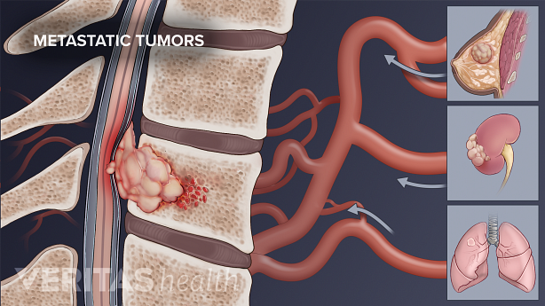 An illustration showing spinal tumors