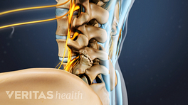 Profile view of spinal stenosis in the lumbar spine.