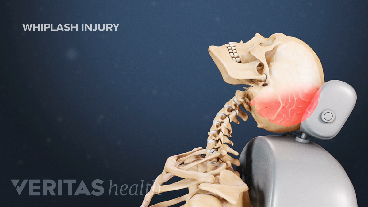 Facet Joint Injections And Medial Branch Blocks | Spine-health