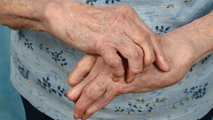 Close up of arthritic hands