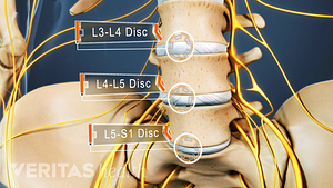 Medical illustration of the lumbar spine. The L3-L4, L4-L5, and L5-S1 discs between the vertebrae are labeled