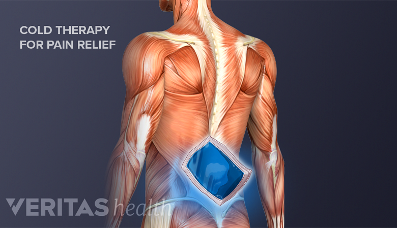 Illustration showing posterior view of torso with a ice pack icon in the lower back.