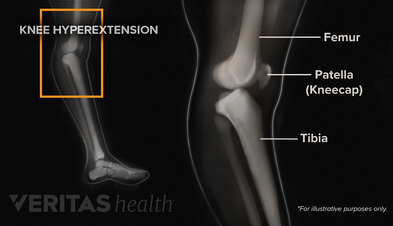 Illustration showing hyperextention of knee joint.