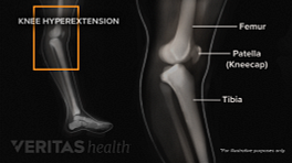 膝过伸x射线标记股骨、髌骨和胫骨