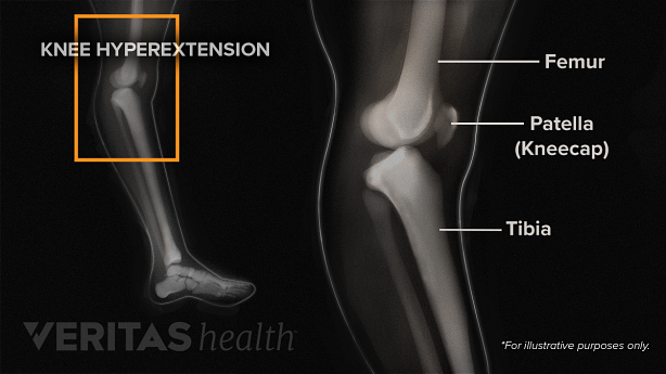 Knee hyperextension x-ray labeling the femur, patella, and tibia