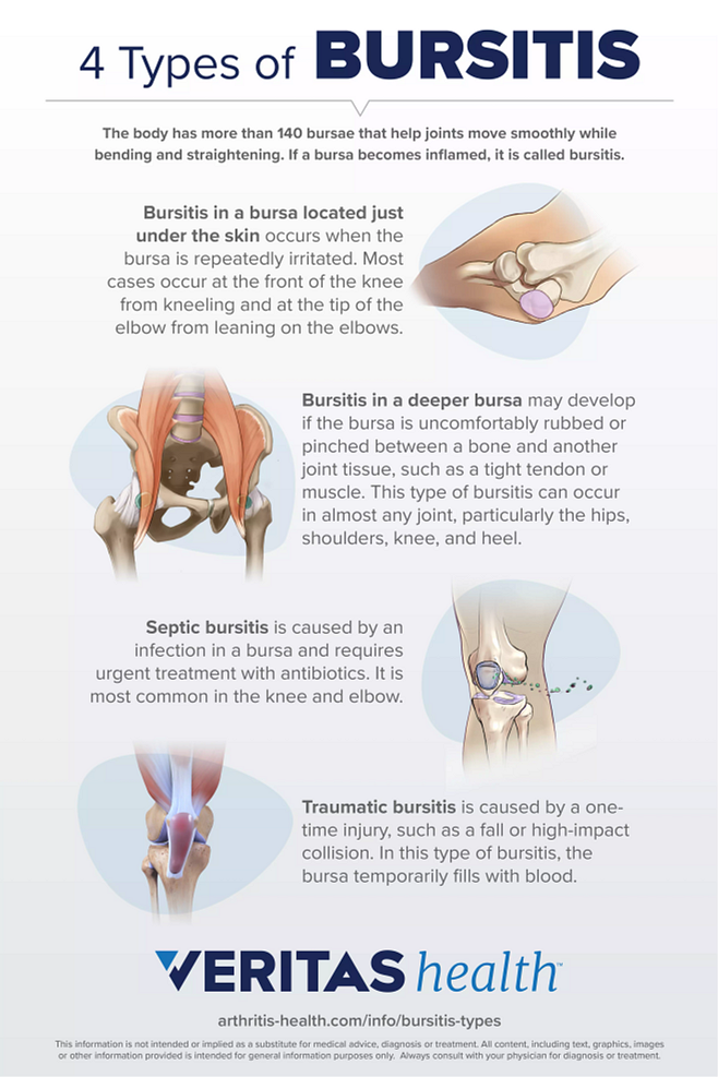 Different Bursitis Hip Treatments