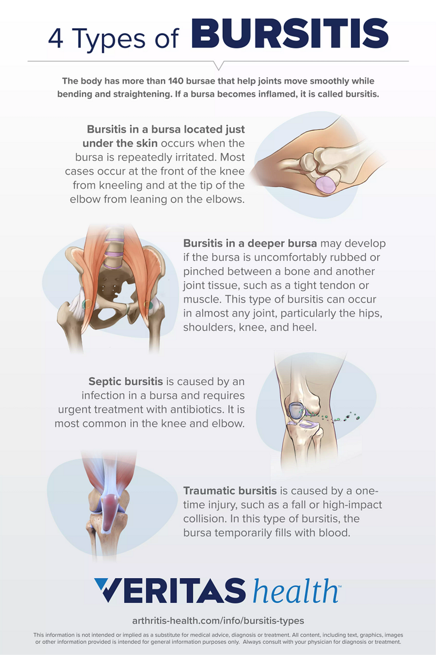 4 Types of Bursitis