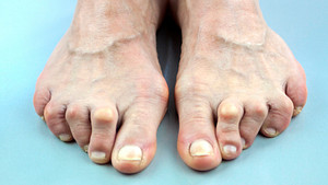 Deformed feet indicating rheumatoid arthritis