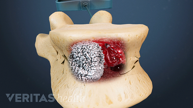 Illustration showing bone cement in the cavity during kyphoplasty.
