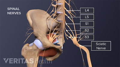 What Is Sciatica & How Is It Treated?
