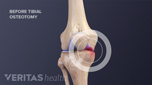 Medical illustration showing pain in the knee joint, and right below the knee joint that may occur before a tibial osteotomy surgery