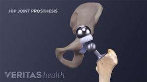 Medical illustration of the hip joint prosthesis assembly