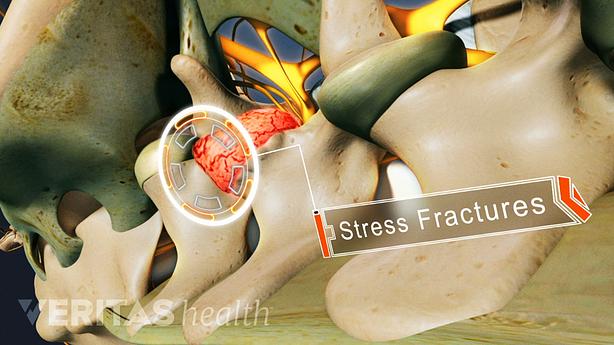 A close up view of a stress fracture of a vertebrae of the spine.
