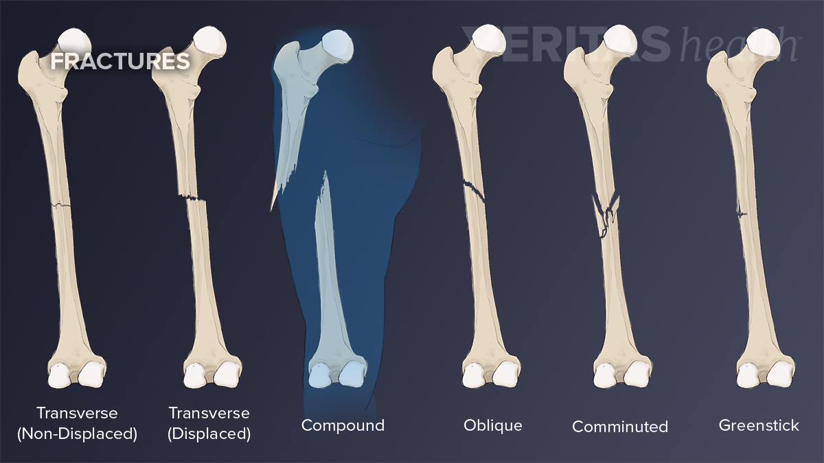 Bone Break Vs. Fracture | Sports-health