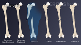 沿着股骨有不同类型的骨折