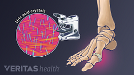 Gout is a type of inflammatory arthritis that occurs from a buildup of uric acid crystals within joints of the body.
