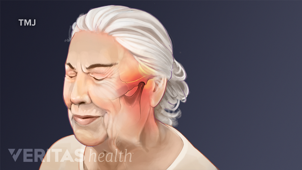 Diagram of woman highlighting areas of the head and neck affected by a TMJ headache.