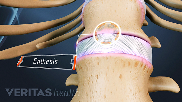 A close up view of an illustrated spine showing two vertebrae and a disc. The connection point between them is called the entheses and it is labeled.