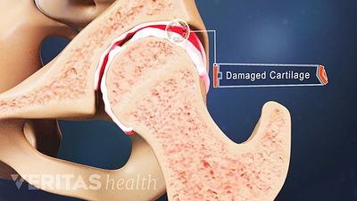 Medical illustration showing damaged cartilage in the hip joint