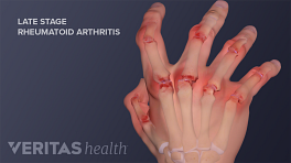 Medical illustration showing late state rheumatoid arthritis joint destruction and deformity in the hands