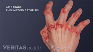 Medical illustration showing late state rheumatoid arthritis joint destruction and deformity in the hands