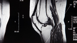 膝盖MRI扫描的剖面视图