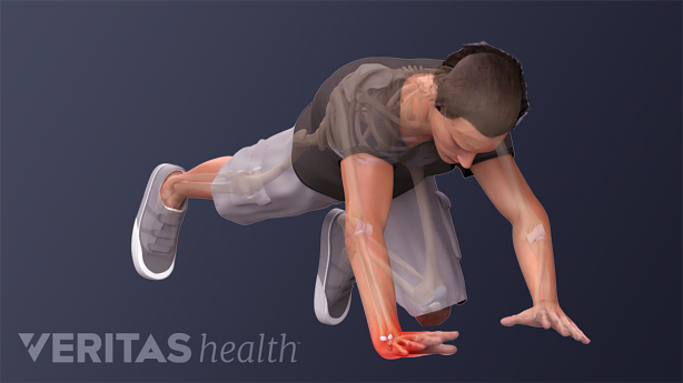 Person falling on his outstretched hand and causing wrist pain