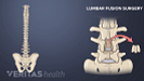 Lumbar spine fusion in the lumbar spine