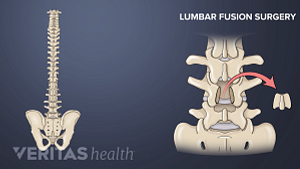 Lumbar spine fusion in the lumbar spine