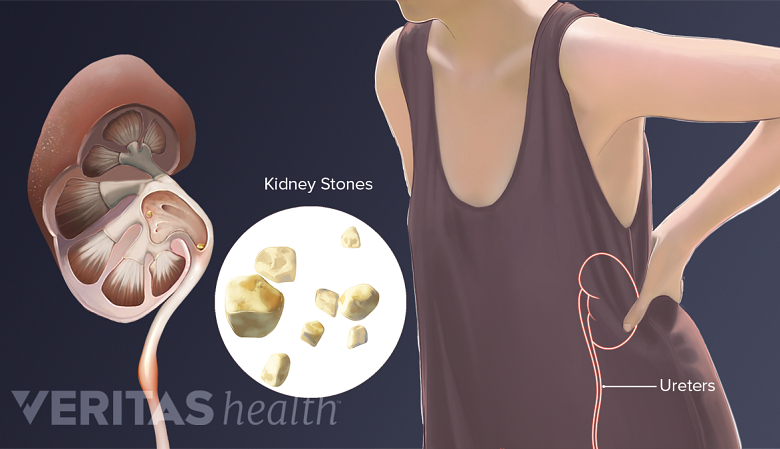 Kidney stones caused by gout.