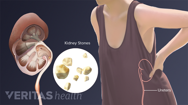 Medical illustration of kidney stones