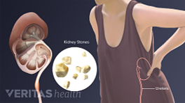 Illustration of kidney stones that are sometimes caused by gout