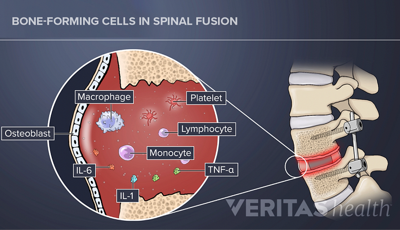 Illustration showing bone healing after lumbar spine fusion.