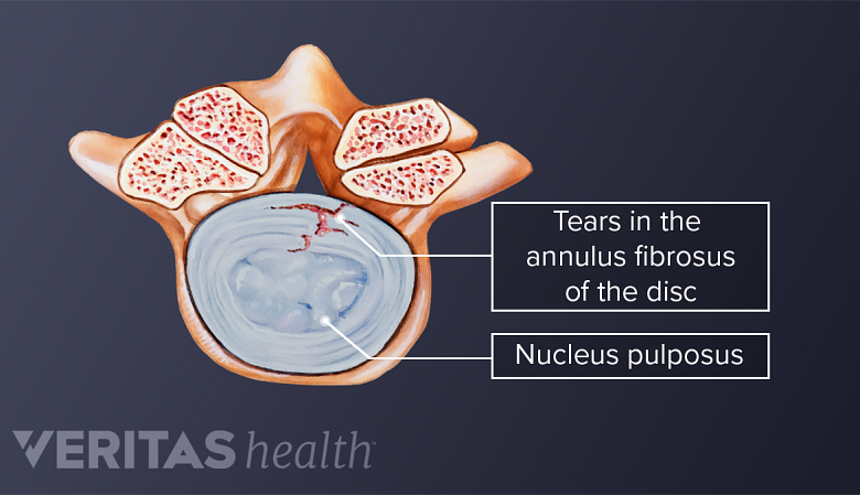 View of tears in the annulus fibrosus of the disc and nucleus pulposus.