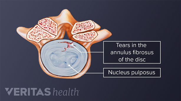 View of tears in the annulus fibrosus of the disc and nucleus pulposus.