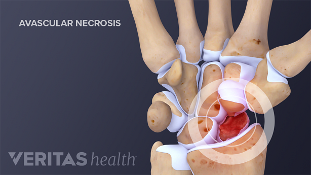 Avascular necrosis of proximal scaphoid fragment