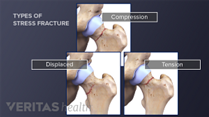 Three types of stress fractures in a hip (tension, displaced, and compression)