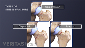 髋关节应力性骨折的三种类型(张力、移位和压迫)