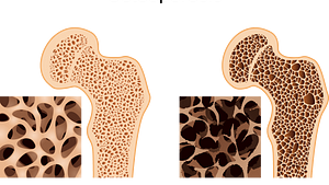 Comparison view of normal bone vs bone with osteoporosis
