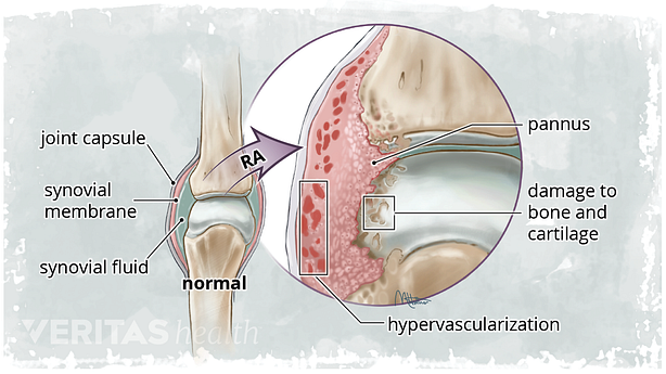 Diagram of healthy pannus vs rheumatoid pannus