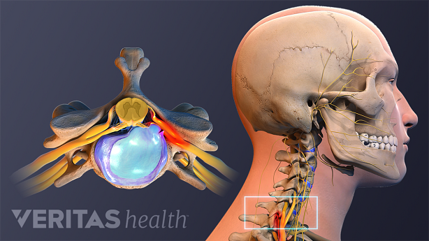 Illustration showing herniated cervical disc and head and neck anatomy showing cervical spine..
