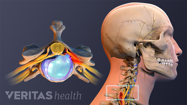 Medical illustration showing cervical herniated disc.