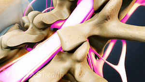 Exposed nerve roots.