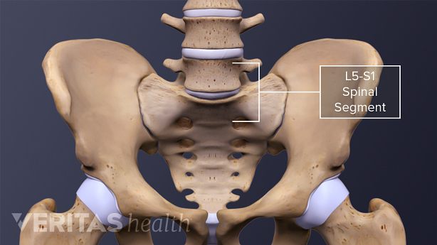 An illustration showing L5-S1 spinal segment in the pelvis.